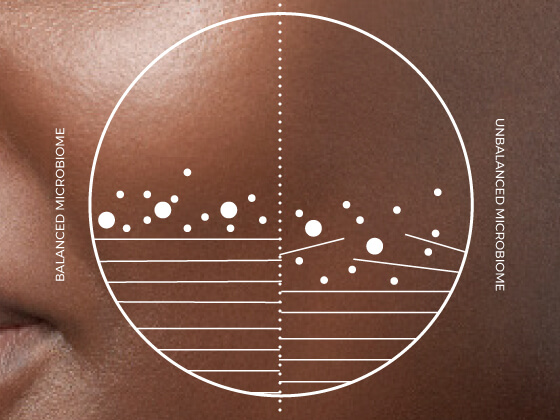 Close-up of skin with a circular graphic overlay divided in two. The left side, labeled "Balanced Microbiome," shows fewer white particles and smoother lines. The right side, labeled "Unbalanced Microbiome," shows more white particles and irregular lines.